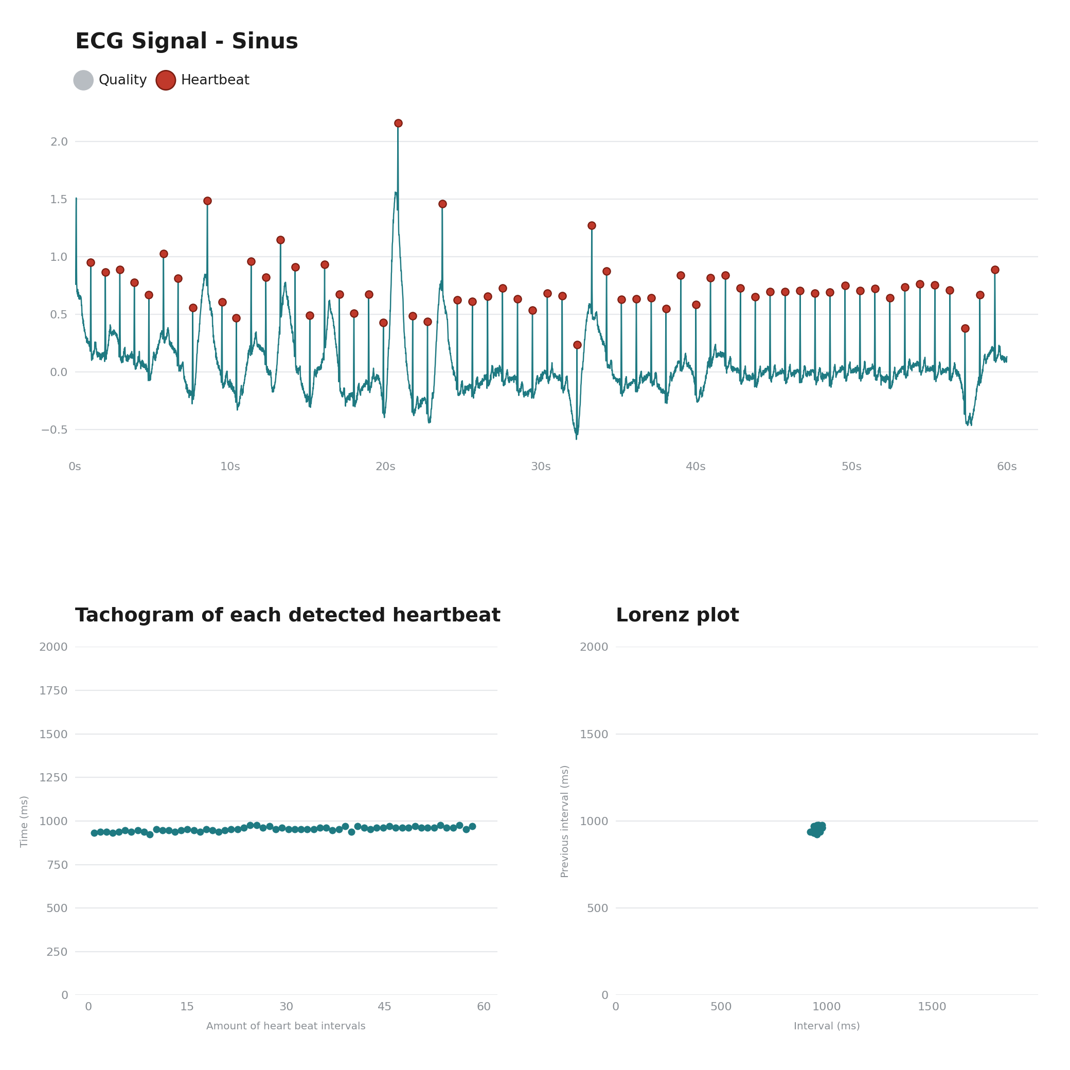 ECG analysis of a regular sinus rhythm